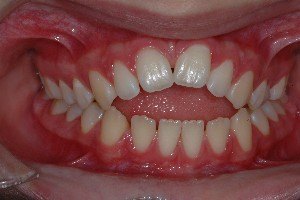 morso aperto, estetica del sorriso apparecchio per i denti